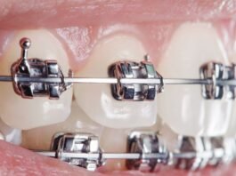 beneficios ortodoncia aparatos