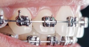 Tratamientos ortodónticos: una forma eficaz de mejorar la calidad de vida beneficios ortodoncia aparatos