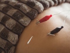 Profesionales aplican punción seca para tratar contracturas musculares persistentes Fisioterapeuta aplicando punción seca en la espalda de un paciente para aliviar dolor muscular.