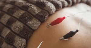 Profesionales aplican punción seca para tratar contracturas musculares persistentes Fisioterapeuta aplicando punción seca en la espalda de un paciente para aliviar dolor muscular.