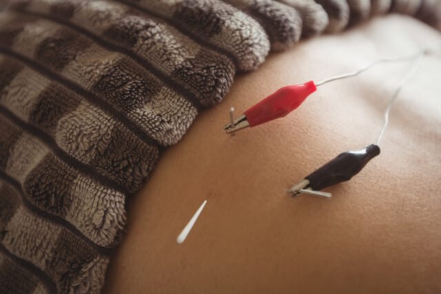 Fisioterapeuta aplicando punción seca en la espalda de un paciente para aliviar dolor muscular.